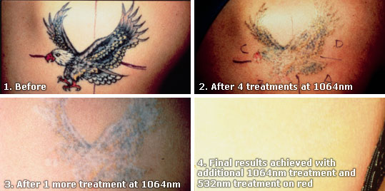 tattoo removal before and after. tattoo removal