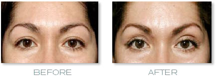 brow lift