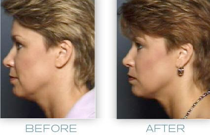 jaw line lift