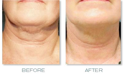 Neck lift